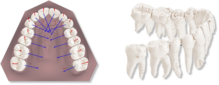 Combining dental roots acquired through CBCT devices with scanned dental crowns.jpg